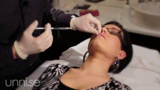 Botox amp Restylane  Behandlingar Biverkningar Läppar Botox amp Restylane [upl. by Ogait]