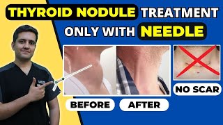 THYROID NODULE TREATMENT WITHOUT SURGERY  COLLOID GOITER TREATMENT  LIVE by Dr Gaurav Gangwani [upl. by Eanehs748]