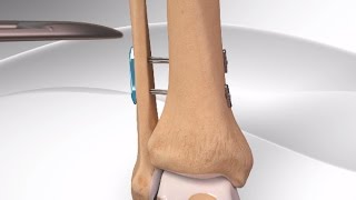 High Ankle Sprain [upl. by Garfinkel]