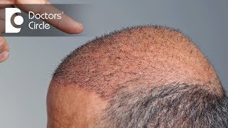 When will newly transplanted hair start to grow  Dr Niranjana Raj [upl. by Attennaej]