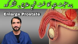 Enlarge prostate gland or benign prostate hyperplasia BPH [upl. by Austen346]