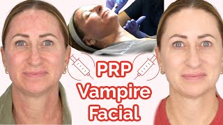 Microneedling PRP FACIAL Experience BEFOREAFTER Vampire Facial Over 40 [upl. by Nitnilc515]