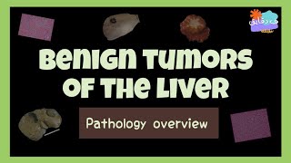 Benign tumors of the liver  hepatobiliary surgery  pathology overview عربي [upl. by Nadnarb]