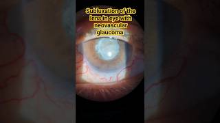 Subluxation of the lens in the eye with neovascular glaucoma  Підвивих кришталика [upl. by Etolas447]