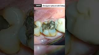 Old Amalgam Filling replace with Onlay  Tooth Onlay Restoration shorts dentist onlay viral [upl. by Huber]