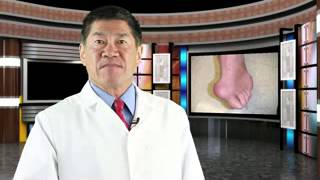 Gout  anakinra for refractory gout [upl. by Bubalo]