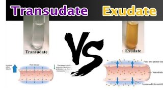 Transudate and Exudate pathology transudate Vs ExudateEasy to understand pathology [upl. by Feenah]