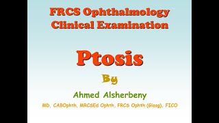 FRCS Ophthalmology Clinical Examination  Ptosis [upl. by Tansy165]