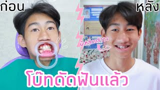 โบ๊ทดัดฟัน ครั้งแรกในชีวิต EP1 ใส่เหล็กแล้วว [upl. by Routh]