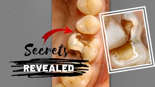 Secrets of Caries Excavation Revealed  Dentistry [upl. by Eekcaj]