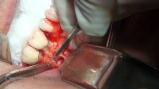 Dental Case 02  Dr Alexander V Antipov [upl. by Curley]