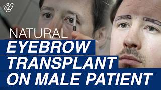 Eyebrow Transplant for MEN  Get the Perfect Eyebrows [upl. by Einahpet]