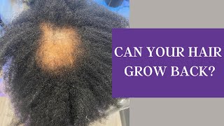 Can Your Hair Grow Back Discover the Answers Here [upl. by Cheyne]