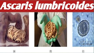 How To diagnose  Ascaris Lumbricoides [upl. by Lajes]