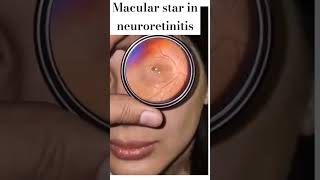 Macular star in neuroretinitis shorts viral education retina eye indirect Ophthalmoscope [upl. by Arba890]