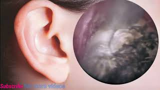 Satisfying Video Ear Wax Removal  how to remove ear wax removal by endoscopic long video 5 [upl. by Godart]