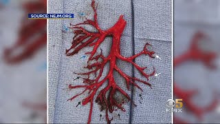 Man Coughs Up 6Inch Blood Clot in Shape of a Bronchial Tree Dies [upl. by Akiemehs768]