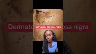 Why Do I Have These Dark Skin Spots Understanding Dermatosis Papulosa Nigra [upl. by Mirella]