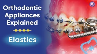 Orthodontic Appliances Explained  Elastics [upl. by Ahsien]