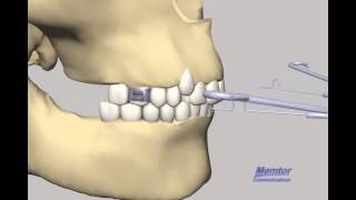 Head gear Orthodontic Head gear [upl. by Laicram]