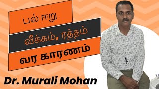 பல் ஈறு வீக்கம் ரத்தம் வர காரணம்  Gum swelling bleeding for reason [upl. by Sheppard124]