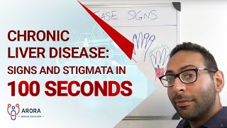 Chronic Liver Disease Signs and Stigmata in 100 seconds [upl. by Arym]