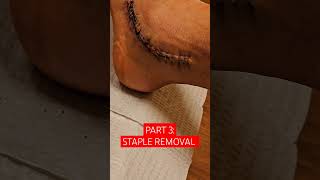 PART 3 STAPLE REMOVAL FROM SURGICAL INCISION surgeryrecovery surgerynature asmr [upl. by Tram]