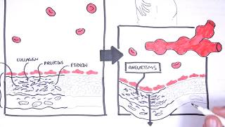 Polyarteritis Nodosa and Kawasaki Disease Medium Vessel Vasculitis  Symptoms pathophysiology [upl. by Rockey]