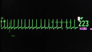 atrial fibrillation with rapid ventricular rate on an ECG heart monitor [upl. by Haidabej477]