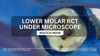 Microscopic Endodontics  Lower Molar RCT  CJ Optik Flexion [upl. by Tisha]