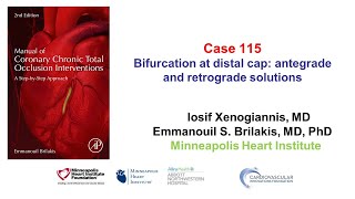 Case 115 Manual of CTO Interventions  Bifurcation at distal cap and retrograde crossing [upl. by Rebmyk]