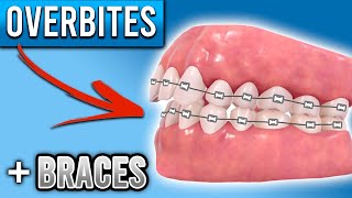 How Do BRACES FIX Overbites  Overbite Before and After Braces  Premier Orthodontics [upl. by Aroc]