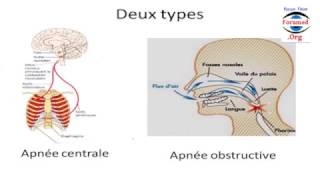 Faites Vous des Apnées de Sommeil [upl. by Yddub]