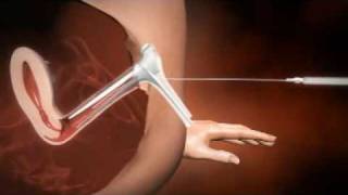 3D animation of how IUI works [upl. by Madlin]