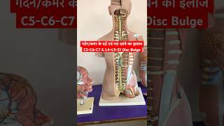 Cervical Problem amp Lower Back Pain Treatment shorts sciatica neckpain [upl. by Emya]