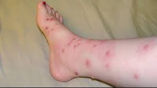 How to Identify an HIV Rash [upl. by Gerdi53]