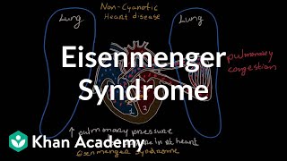 What is Eisenmenger syndrome  Circulatory System and Disease  NCLEXRN  Khan Academy [upl. by Augustina]