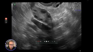 antral follicle count [upl. by Attegroeg]