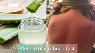 How to get rid of sunburn fast  sunburn treatment at home [upl. by Zurciram]