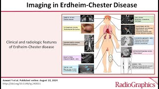 Imaging in ErdheimChester Disease dr Sara NASR [upl. by Yrem728]