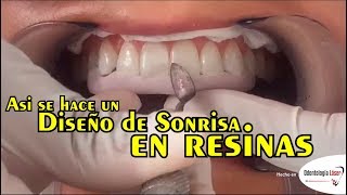 Asi se hace un Diseño de Sonrisa en resinas  Odontología Láser DiseñoDeSonrisa [upl. by Gnoy353]