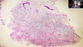 Tip63 Myometrial Myxoidosis [upl. by Ardnuahc]