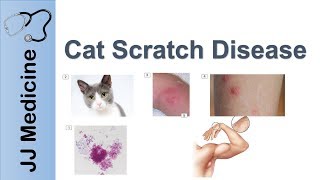 Cat Scratch Disease  Causes Symptoms and Treatment [upl. by Vashtee]