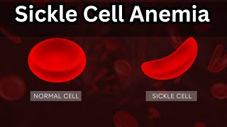 What is sickle cell amemia  Sickle cell anemia  Blood disorders [upl. by Christie]