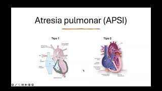 Atresia pulmonar [upl. by Hoashis]