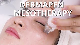 Dermapen Mesotherapy  How Microneedling Treatment Is Done  NV6130 MYCHWAY VIDEO [upl. by Mozza]