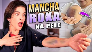 DO NADA Aparece MANCHA ROXA na Pele Saiba Tirar o Roxo da Pele e Descubra as Causas [upl. by Hgielanna]