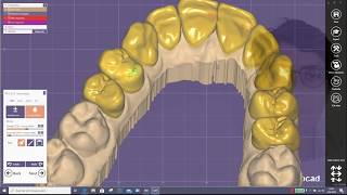 Plovdiv 24 Snap on Smile Tutorial Second part [upl. by Audwin]