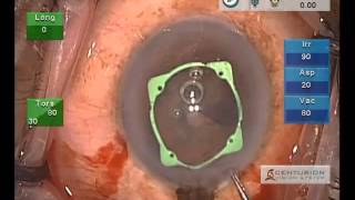 Beaver Visitec Pupil expander in small pupil [upl. by Malvie598]