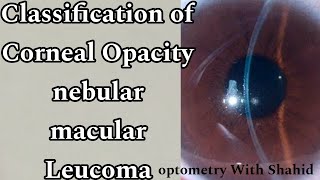 Classification Of Corneal Opacity  Nebular macular Leucoma  Optometry with Shahid [upl. by Salvucci341]